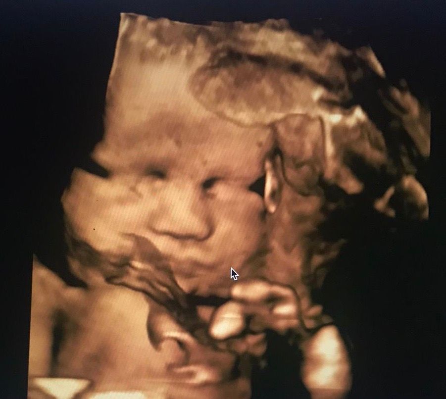 Ultrasound image of my daughter